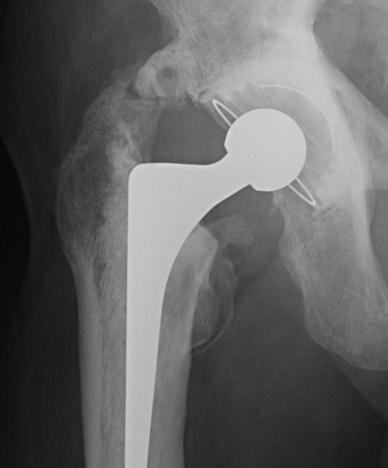 Heterotropic Bone Brooker 3